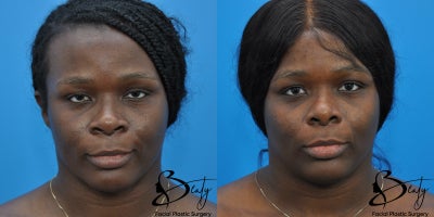 21-30 year old woman treated with Alarplasty, Brow Lift, Facial Fat Transfer - 21-30 year old woman treated with Alarplasty, Brow Lift, Facial Fat Transfer