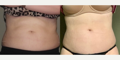 18-24 year old woman treated with truSculpt iD - Trusculpt ID to abdomen and flanks