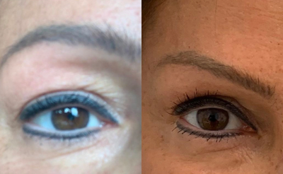 45-54 year old woman treated with Secret RF - Before and after one Secret Rf treatment , which combines radio frequency and microneedling for a lift and rejuvenation of the eyes without surgery.