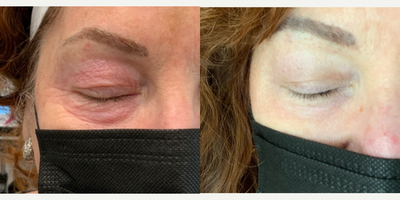 65-74 year old woman treated with Eye Bags Treatment - Subnovii plasma pen treatment on upper and lower eyes for under eye laxity and upper lid hooding. This is 1 month post treatment.