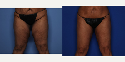 35-44 year old woman treated with Thigh Lift - This 42 year old female is shown 3 months after a medial thigh lift. She had lost 130 pounds with weight loss surgery.