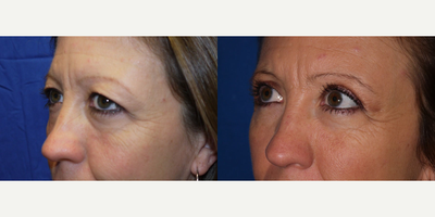 Eyelid Surgery - Patient was tired of being told she looked tired. Pt wanted to look her age and not look older.