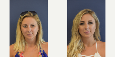 25-34 year old woman treated with Lip Augmentation - Lip Augmentation using Juvederm