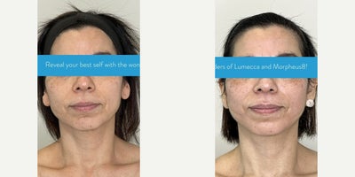 Woman treated with Morpheus8, Lumecca - After 3 sessions of Morpheus8 and 2 sessions of Lumecca, this transformation speaks for itself.