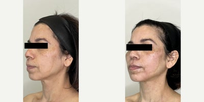 Woman treated with Morpheus8, Lumecca - After 3 sessions of Morpheus8 and 2 sessions of Lumecca, this transformation speaks for itself.