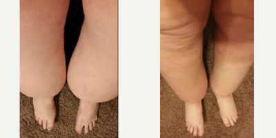 55-64 year old woman treated with Liposuction for lipedema stage 3 calves and ankles - 57 year old patient with stage 3 lipedema underwent liposuction surgery for calves and ankles. 11 pounds of pure fat was removed from that area in one surgery. I have pioneered and developed a unique three- dimensional, circumferential multi-system approach and have improved the quality of life in more than 500 lipedema patients.