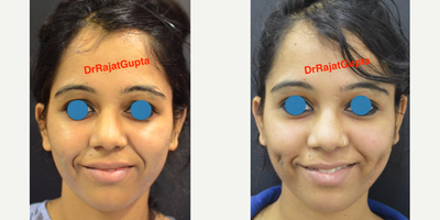 18-24 year old woman treated with Dimpleplasty - incisions from inside the cheek to create a vertical dimple!!