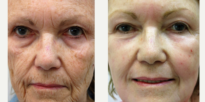 65-74 year old woman treated with Chemical Peel - Deep Chemical Peel