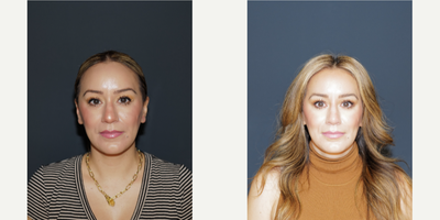 Nonsurgical Nose Job - Nonsurgical Nose Job to lift tip and smooth profile