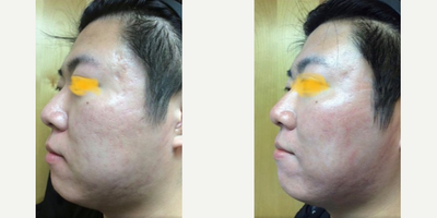 Man treated with Fraxel Laser - Man treated with Fraxel Laser