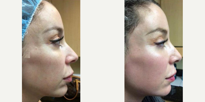 Woman treated with Fraxel Laser - Woman treated with Fraxel Laser
