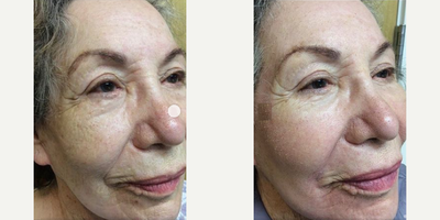 Woman treated with Fraxel Laser - This patient is only 9 days post treatment and still peeling but her results are amazing and will only get better with time