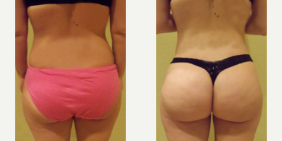 Woman treated with Butt Augmentation - Woman treated with Butt Augmentation