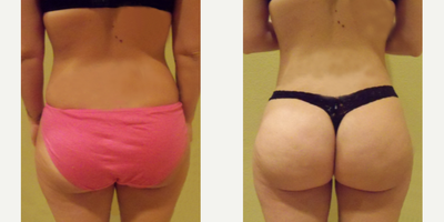 Woman treated with Butt Lift - Woman treated with Butt Lift