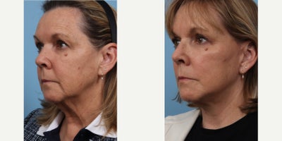 65-74 year old woman treated with Deep Plane Facelift, Eyelid Surgery - Deep Plane Facelift and Upper Eyelid Blepharoplasty
