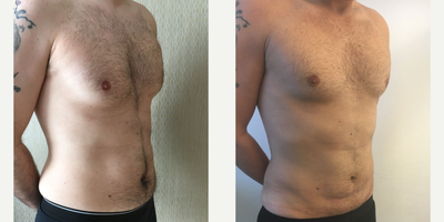 35-44 year old man treated with Vaser Liposuction - Vaser Liposuction Surgery performed by Ozge Ergun, MD (This is the result of 2 months post operative)