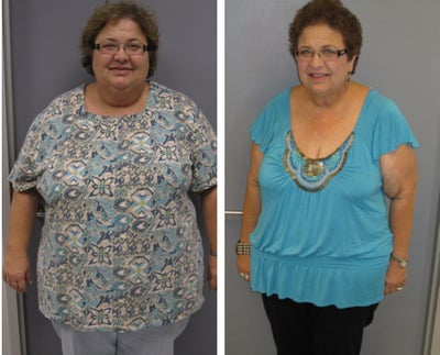 Before & After - 
	9 months post-op
