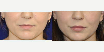 18-24 year old woman treated with Restylane - 23 year old treated with Restylane in her lips to add more volume to her upper lip so it is more visible and I injected a little into the lower lip to balance them out. Here she is 3 weeks post injections.