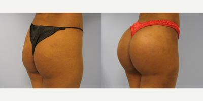 18-24 year old woman treated with Butt Implants - Intramuscular 440 cc smooth round silicone implants
