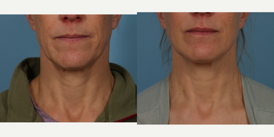 55-64 year old woman treated with Sculptra, Radiesse - A biostimulant is an injectable that promotes your bodys own collagen and elastin production. This treatment is perfect for someone who is looking for natural appearing results over a gradual period of time.  Sculptra was placed for structural support in the patients cheeks, under eye, temples and jawline. Hyperdilute Radiesse was placed in the jawline and neck for skin tightening and improved skin texture. Her skin is noticeably more youthful and brighter, with her jawline lifted and neck skin tightened. This patient received 3 treatments of Sculptra and 2 of 3 planned treatments of Hyperdilute Radiesse. She has already had an incredible transformation over a period of weeks to months and her final result is yet to come!