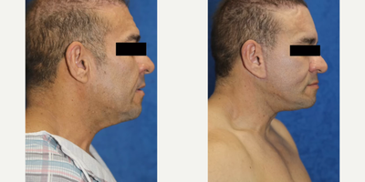 35-44 year old man treated with Brow Lift, Neck Lift, Facelift - This patient in his mid 40s had a brow lift, buccal fat removal, neck lift, and facelift. He disliked his frown lines and wanted a more youthful appearance.