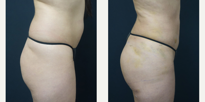 35-44 year old woman treated with Brazilian Butt Lift - Brazilian Butt Lift with Fat Injection - 7 days post-op