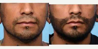 25-34 year old man treated with Hair Loss Treatment - Sneak preview of an FUE Beard Transplant with 2000 grafts. After photo taken 2 weeks post-op. The growth process is just beginning for this patient.