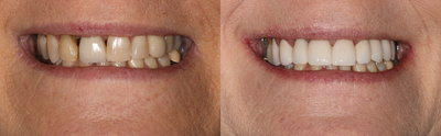 45-54 year old woman treated with Dental Crown - Smile makeover done with crowns
