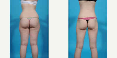 35-44 year old woman treated with Abdominal Etching, Laser Liposuction, Liposculpture, Liposuction, Power-Assisted Liposuction ( - before and after VASER ultrasound assisted liposuction abdomen/flanks; lipo 360. Liposuction is the most popular plastic surgery procedure with about 350,000 procedure done in 2023. Good candidates for liposuction have normal or near normal weight but have discrete problem areas with discrete pockets of fat. Another charateristic of a good liposuction candidate is skin quality. Younger patients with good skin quality and few stretch marks with little to no overhang or excess skin are the best candidates. Vaser is an ultrasound device that melts fat and tightens tissue making liposuction more precise with less bruising and swelling. In this case I did liposuction with VASER assistance removing about 1.5 from her abdomen and flank areas (Lipo 360).