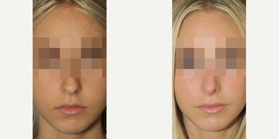 Woman treated with Rhinoplasty - Woman treated with Rhinoplasty