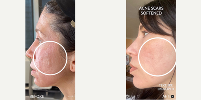 Woman treated with Bellafill, Subcision, CO2 Laser, PlasmaPen - Woman treated with Bellafill, Subcision, CO2 Laser, PlasmaPen