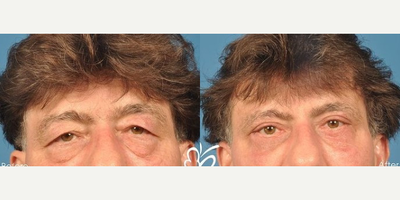 Man treated with Eyelid Surgery - Man treated with Eyelid Surgery