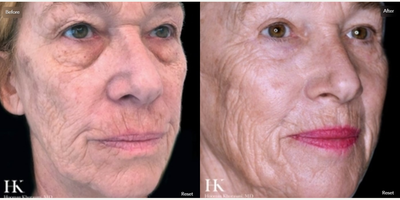 Woman treated with TotalFX - Woman treated with TotalFX