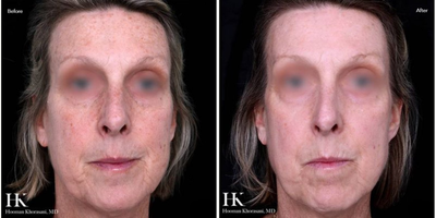 Woman treated with TotalFX - Woman treated with TotalFX