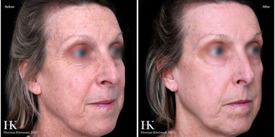 Woman treated with TotalFX - Woman treated with TotalFX