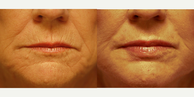 55-64 year old woman treated with Phenol Peel - A modified phenol peel is less harsh than the stronger phenol peels used in the past and allows a custom treatment for various areas of the face and a faster recovery.