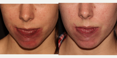 25-34 year old woman treated with Excel V - Patient treated multiple times with Excel V Laser for port-wine stain birthmark on the chin.