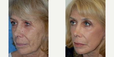 Woman treated with Mini Facelift - Woman treated with CO2 Laser Resurfacing and Mini Facelift.