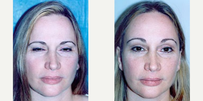 Woman treated with Brow Lift - Woman treated with Brow Lift