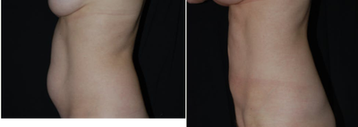 35-44 year old woman treated with Liposuction - Liposuction of the Abdomen and Flanks