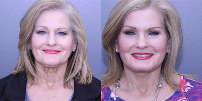55-64 year old woman treated with Fresh Lift - Patient had Lifestyle Lift, Upper and Lower Bleph, FF Laser, and Brow Lift