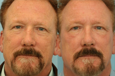 Full Face Photofractional (IPL + Resurfx) - Full Face Photofractional (IPL + Resurfx)