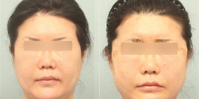 55-64 year old woman treated with Thread Lift - She was concerned about her inner eyebrows being too droopy compared to the outer side. So a thread lift was performed only on the inner eyebrows - a total of 12 threads were used (Mint thread lift / PDO threads )