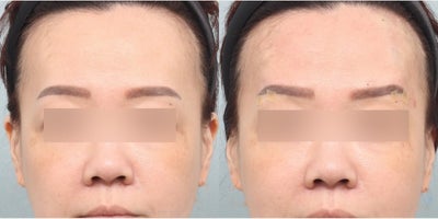 35-44 year old woman treated with Thread Lift - She came to the clinic wanting a fox eyebrow lift/cat eyebrow lift. Thus, she underwent an eyebrow thread lift with 8 threads (Mint thread lift / PDO threads ).