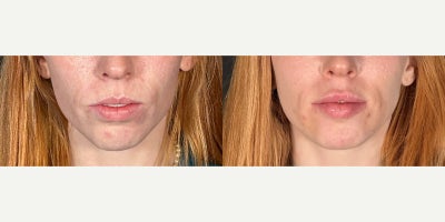 25-34 year old woman treated with Lip Fillers - This stunning transformation highlights the power of strategically placed lip and chin fillers to enhance facial harmony and balance. By adding volume and definition to the lips, we achieved a plumper, more youthful appearance, while the chin filler provided improved structure and profile symmetry. Together, these subtle yet impactful enhancements created a beautifully proportioned and refined look, showcasing how non-surgical treatments can deliver incredible, natural-looking results.