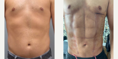 Man treated with Abdominal Etching - Man treated with Abdominal Etching as well as Vaser Liposution 360