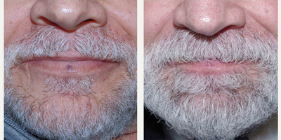 55-64 year old man treated with IPL - 64 year old male was treated with Cynosure (IPL) for a lower lip lesion; photos depict the patient's results 1 month post-fourth treatment.