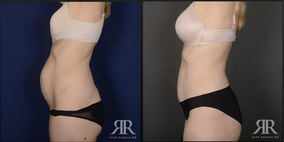 35-44 year old woman treated with Tummy Tuck - Tummy Tuck
