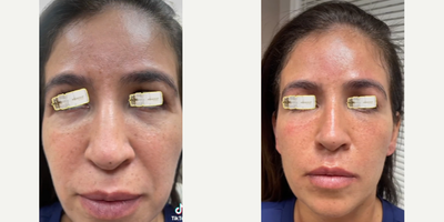 Woman treated with Aquagold - Immediate resultspain-freeno bleedingno bruisingno downtime.We use a very ingenious sterile, disposable device called Aquagold which consists of a small flask and a cap. The flask or bottle is used to mix a cocktail of substances that Dr. Diaz-Yoserev prepares for each individual patient according to his/her skin condition.