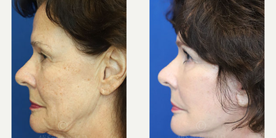 Woman treated with Facelift - Woman treated with Facelift